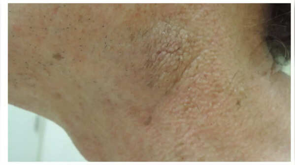 Skin tags and dark patches